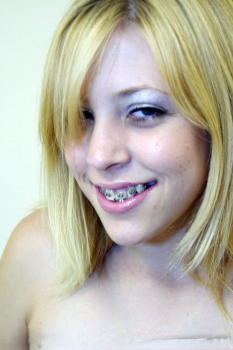teen braces best galleries